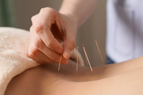 Acupuncture for Fertility, The Science-Backed Benefits for IVF Success